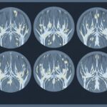 초가공식품 근육 질 변화 첫 영상 기반 확인…무릎 골관절염 위험 연관성 드러나